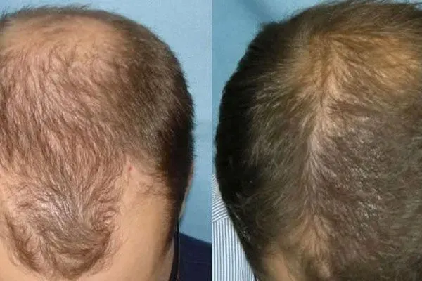 Hair Transplants in London